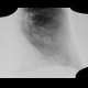 Chondrohamartoma of lingula, lung: X-ray - Plain radiograph